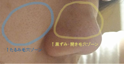 毛穴トラブル個所分布図